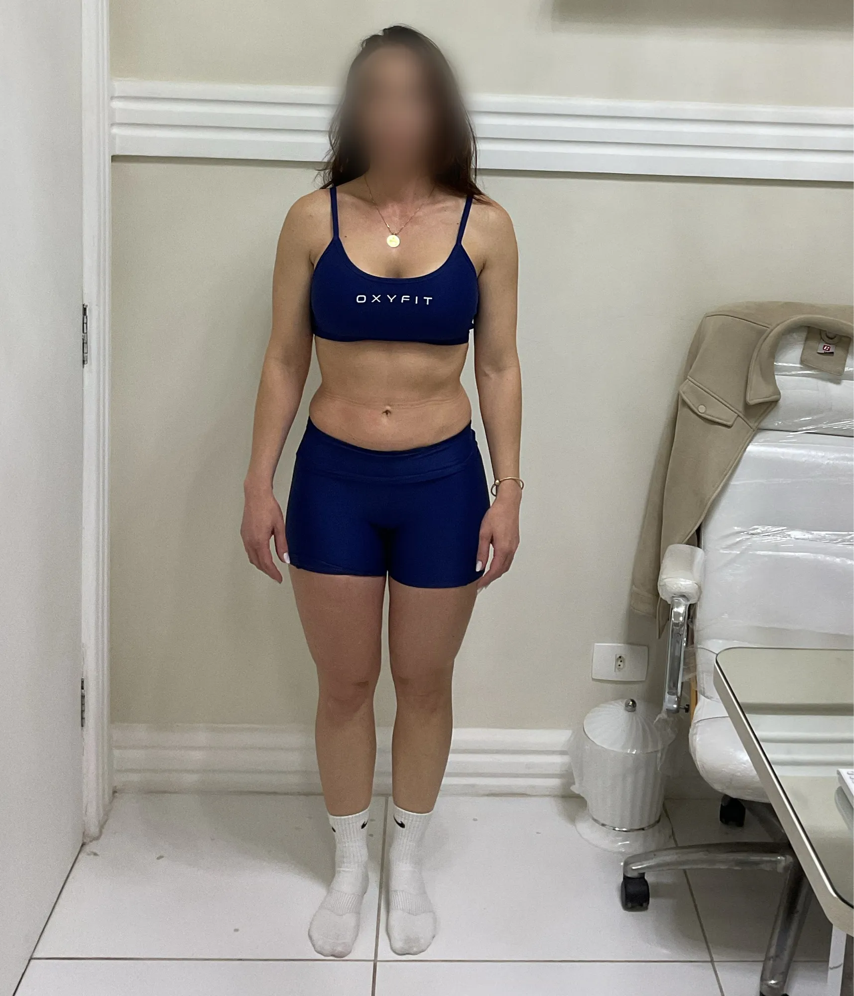 Recomposição — Frontal — antes