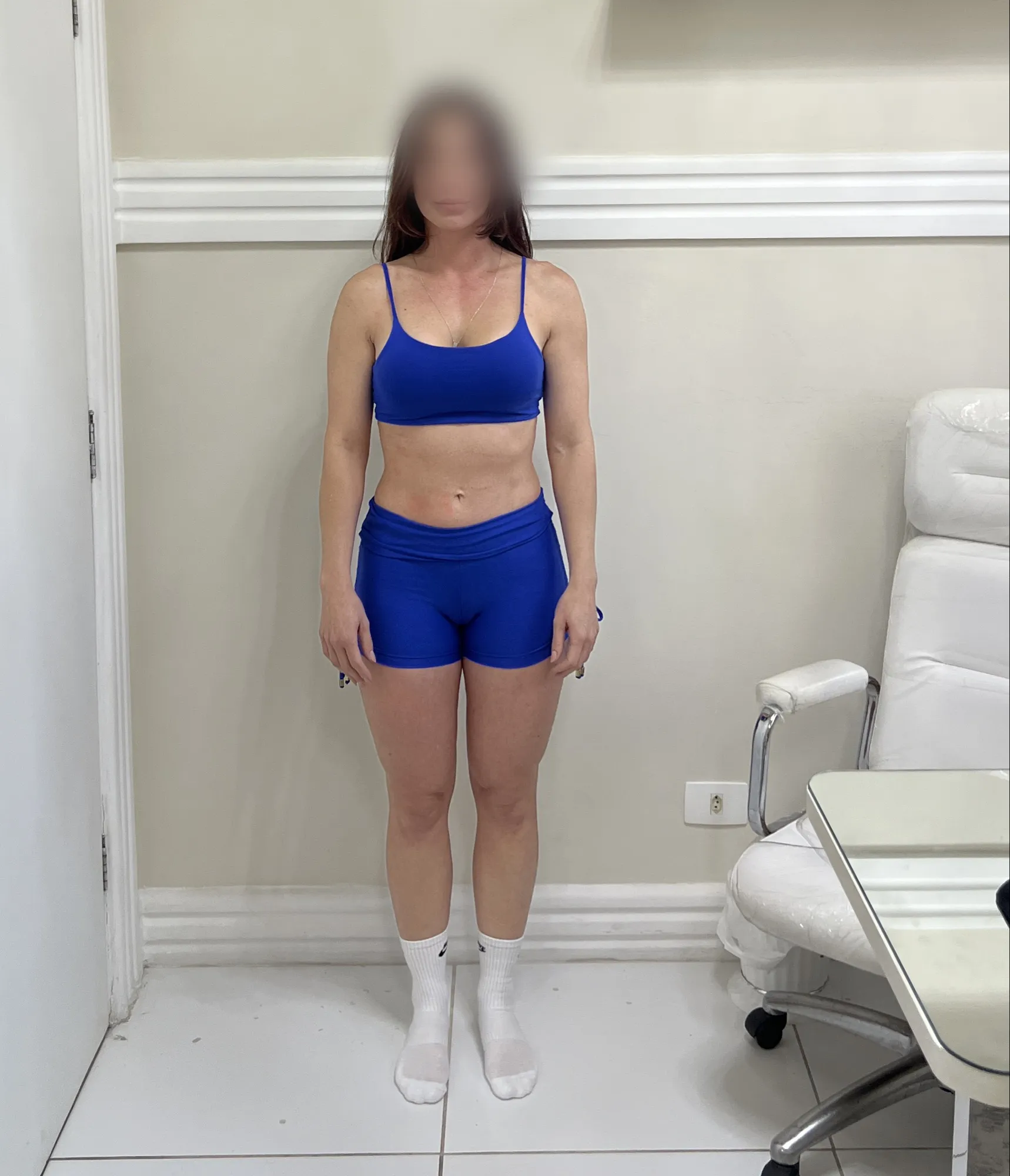 Recomposição — Frontal — depois